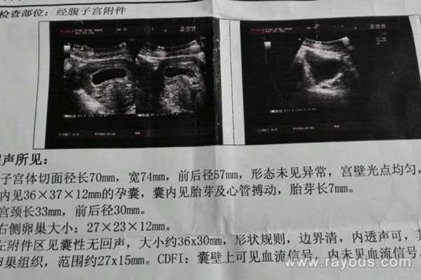 上海代孕生儿子费用，上海中山试管婴儿费用大约多少？